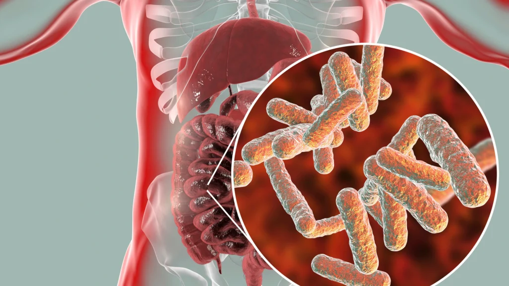 A Clear Guide to Small Intestinal Bacterial Overgrowth